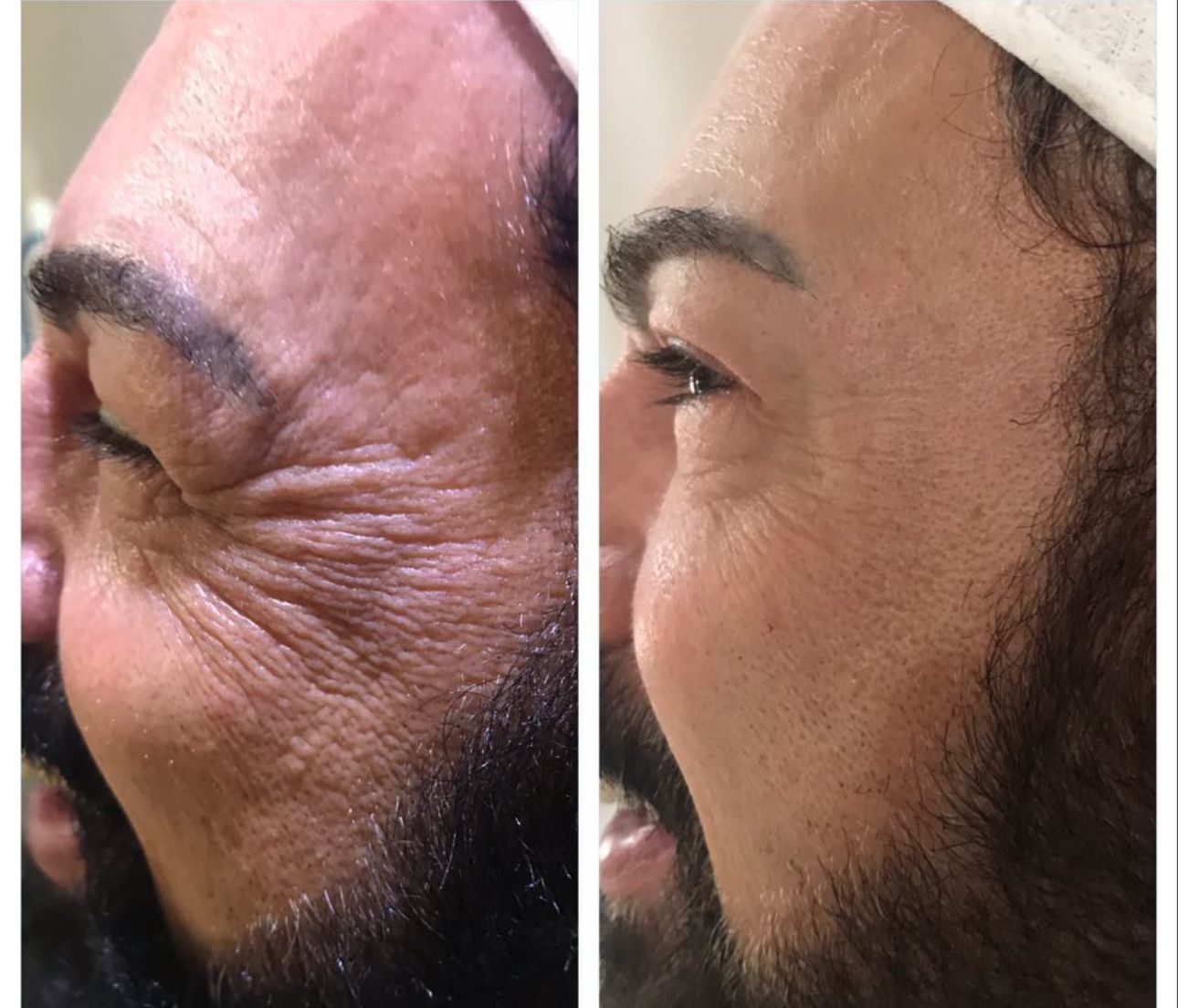Antes e depois — resultado 1