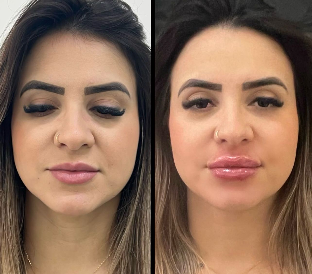 Antes e depois — resultado 4