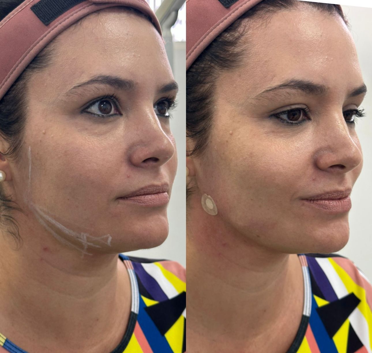 Antes e depois — resultado 5