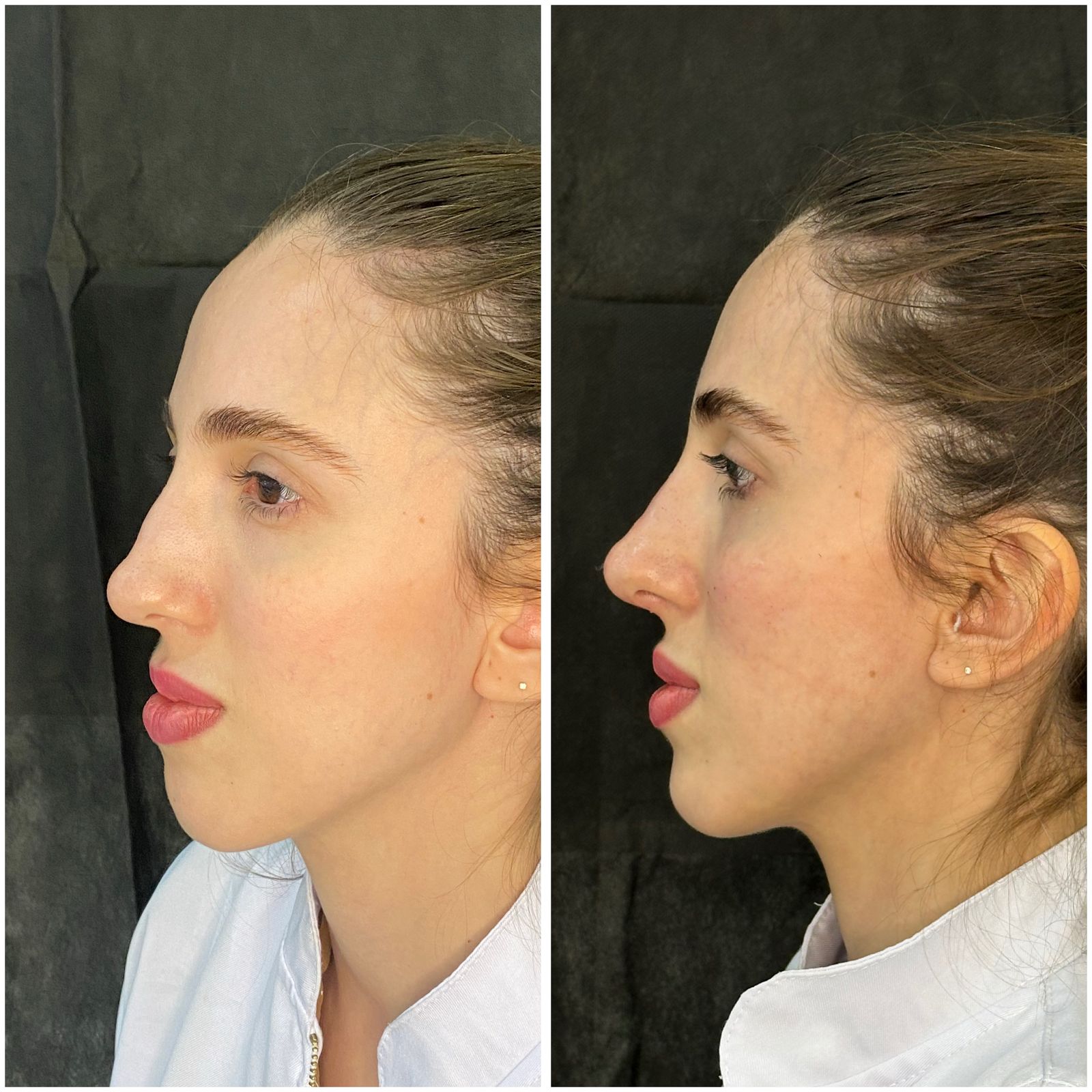 Antes e depois — resultado 6