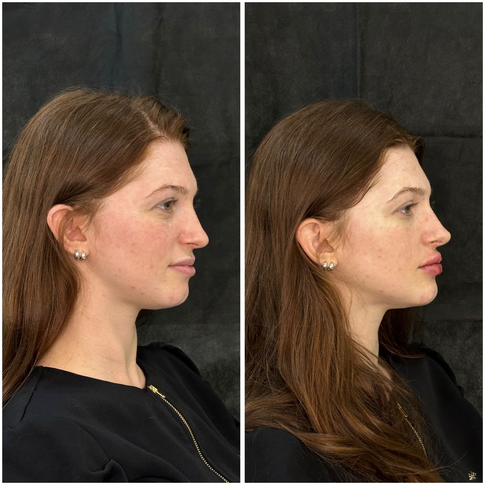 Antes e depois — resultado 7