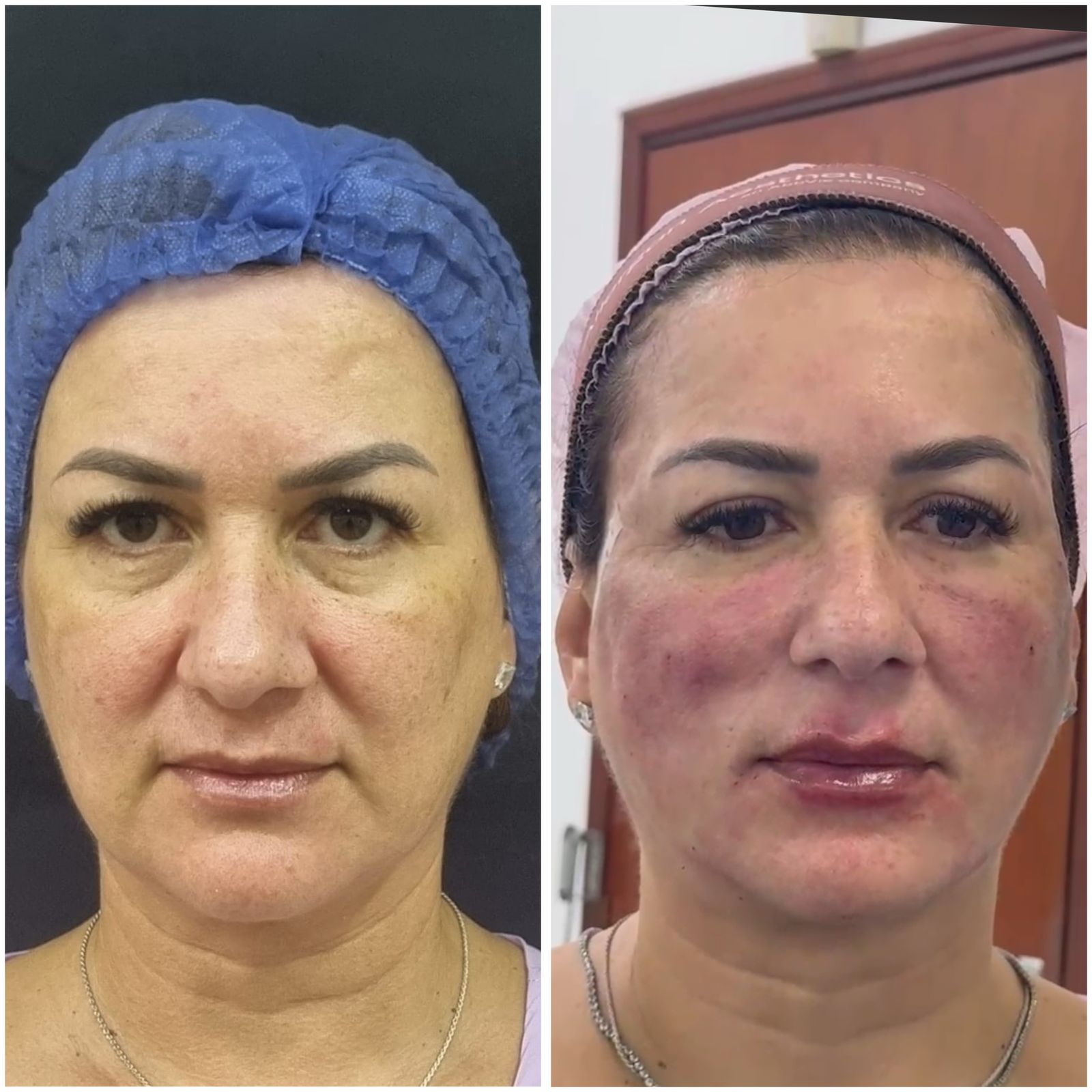 Antes e depois — resultado 8